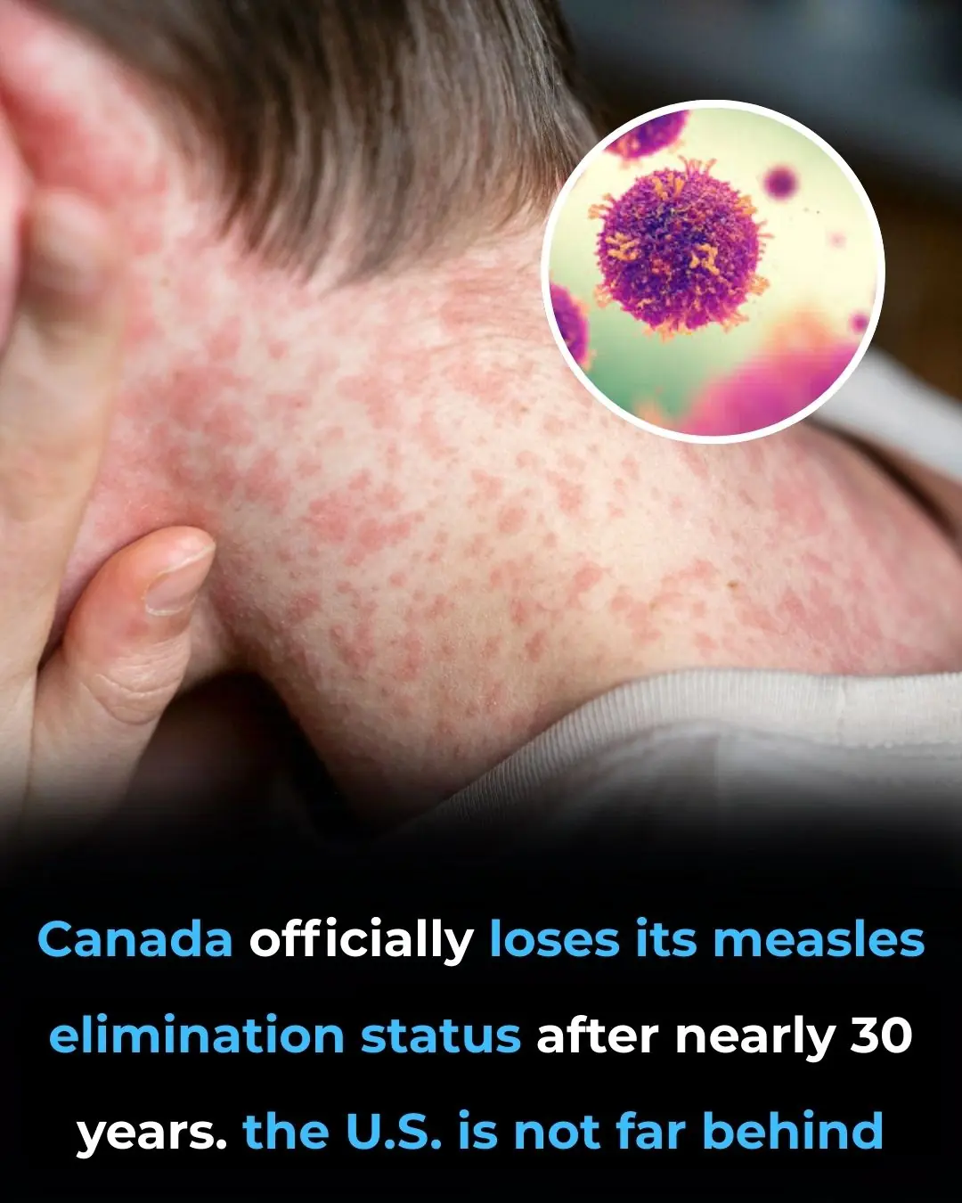 Canada Loses Measles-Free Status After Nearly 30 Years as the U.S. Faces Growing Risk