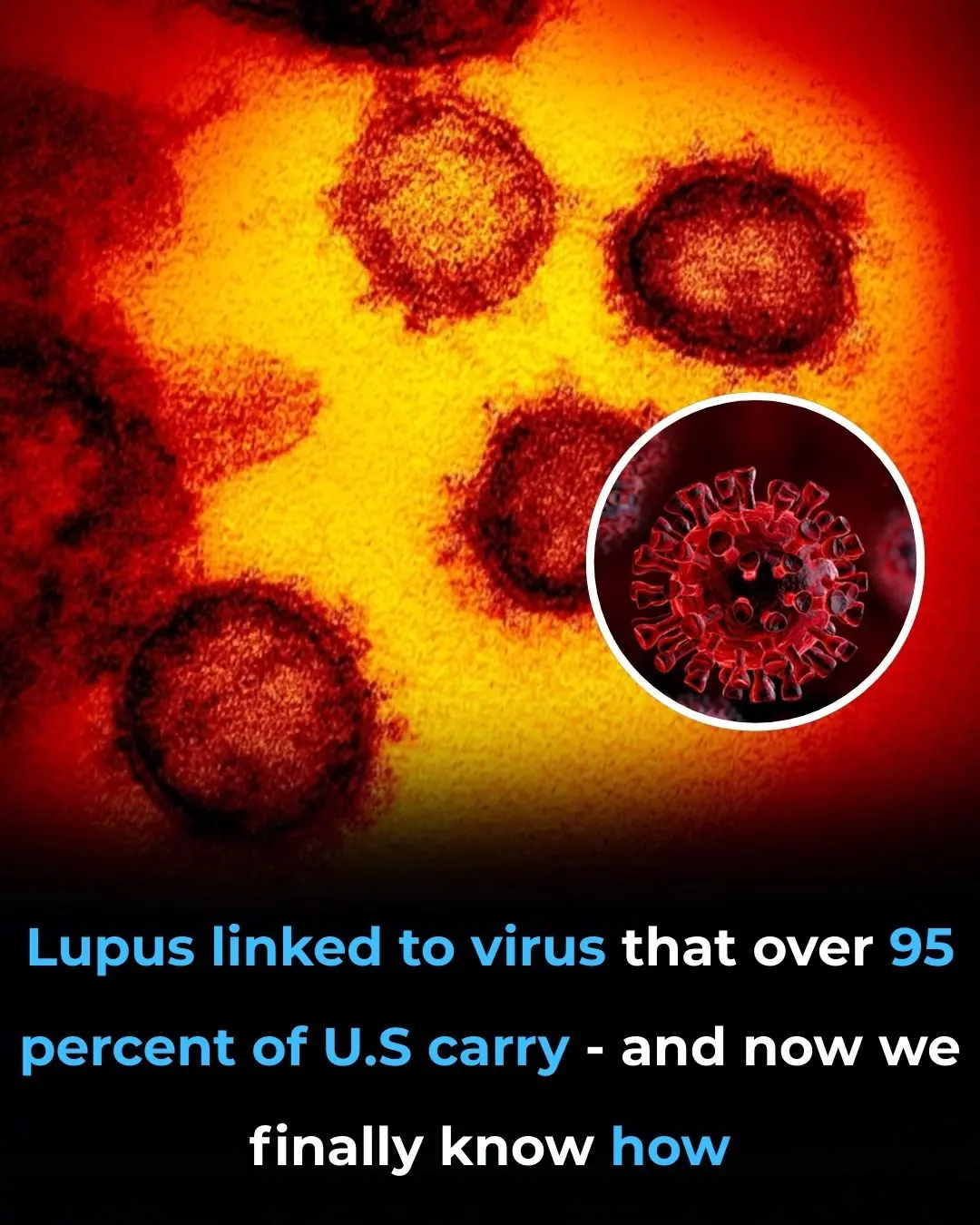 Could a Nearly Universal Virus Be the Root Cause of Lupus