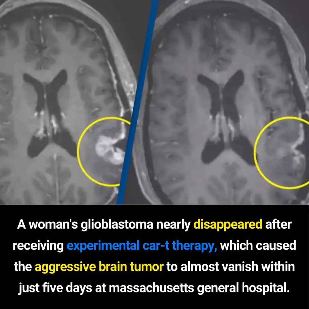 Experimental CAR-T Therapy Shows Dramatic 5-Day Regression of Glioblastoma at Massachusetts General Hospital