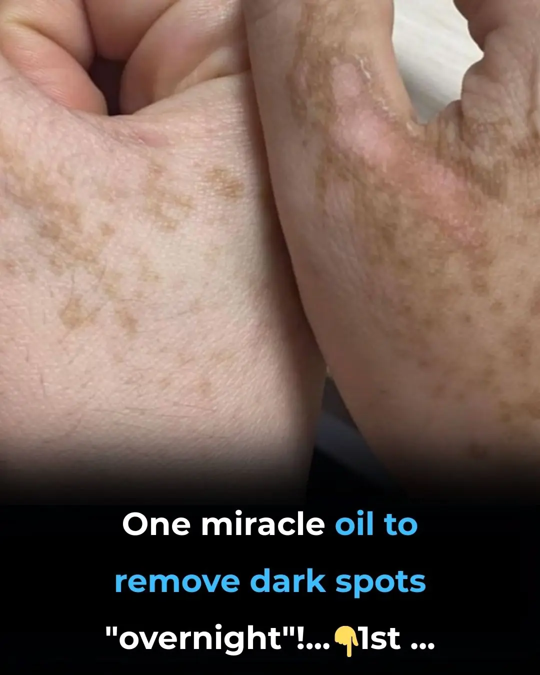 One Miracle Oil to Remove Dark Spots “Overnight”!