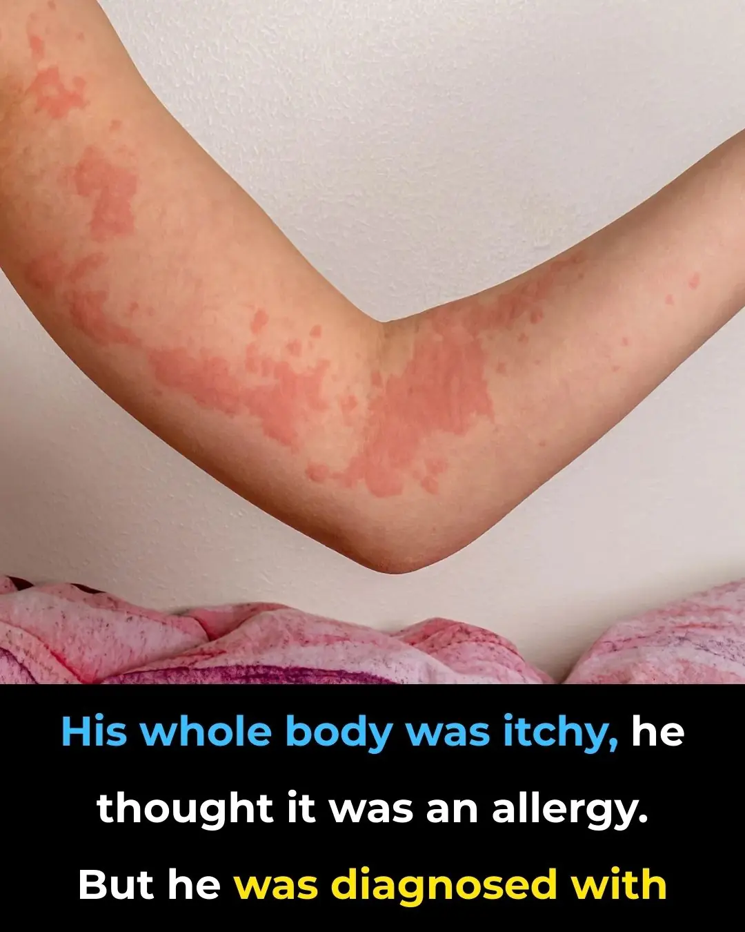 He thought it was just an allergy, until the diagnosis proved otherwise