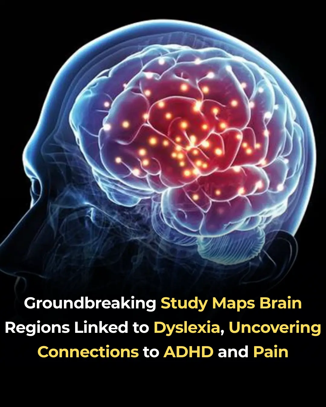 Groundbreaking Study Maps Brain Regions Linked to Dyslexia, Uncovering Connections to ADHD and Pain