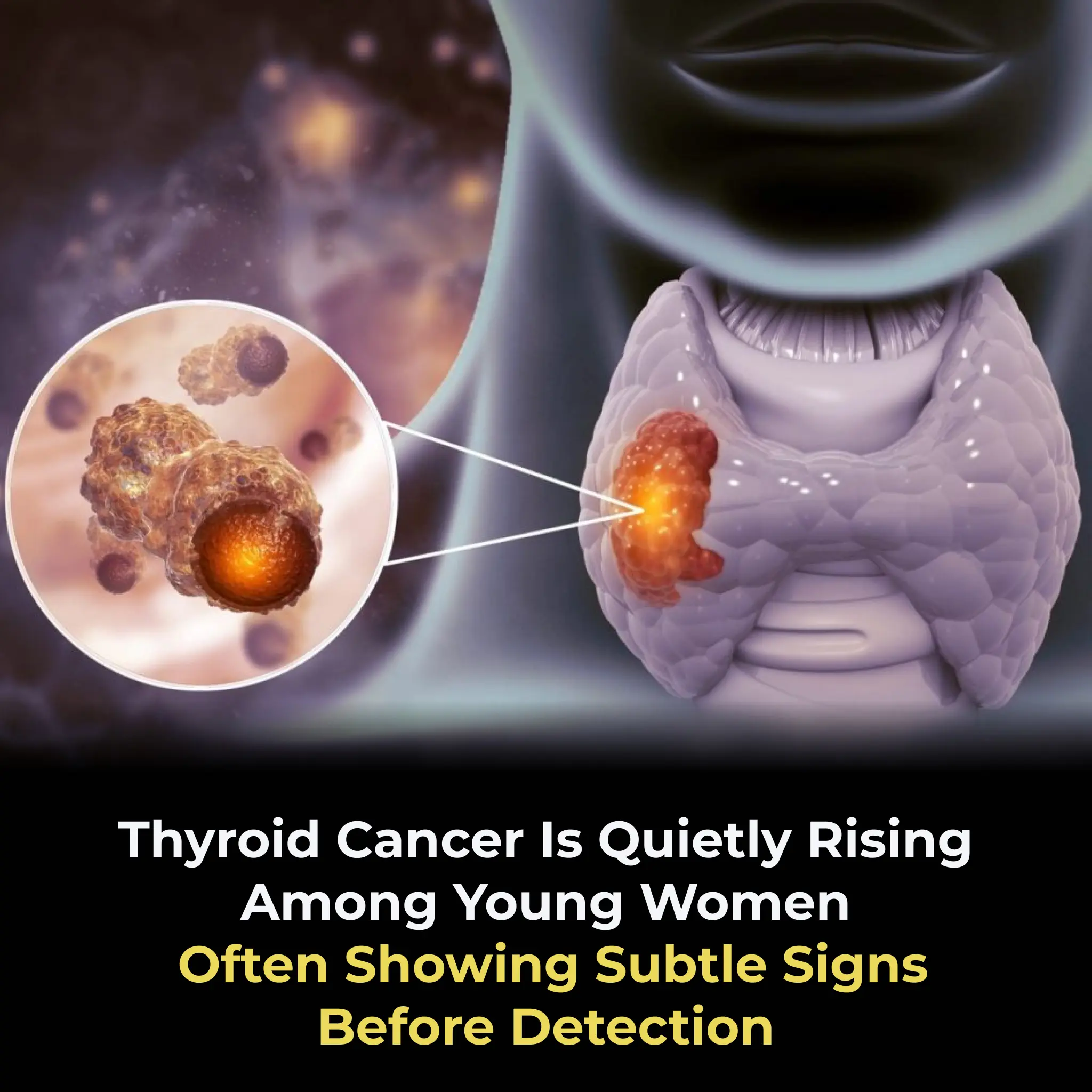 Thyroid Cancer Is Quietly Rising Among Young Women  Often Showing Subtle Signs Before Detection