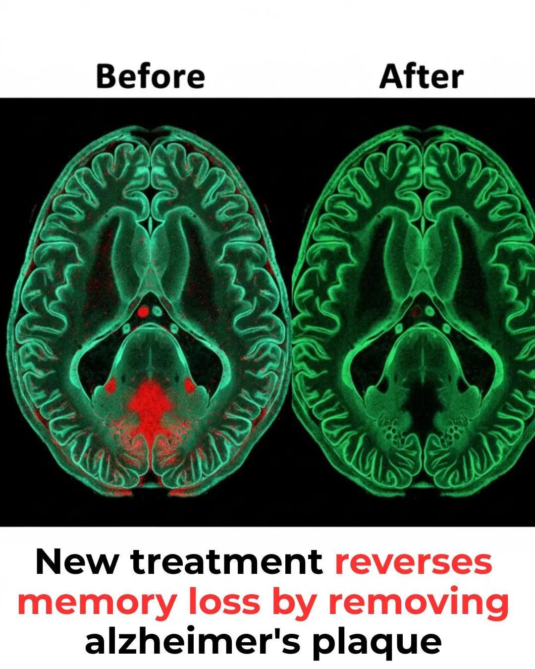Alzheimer’s Breakthrough: A New Era in Reversing Memory Loss