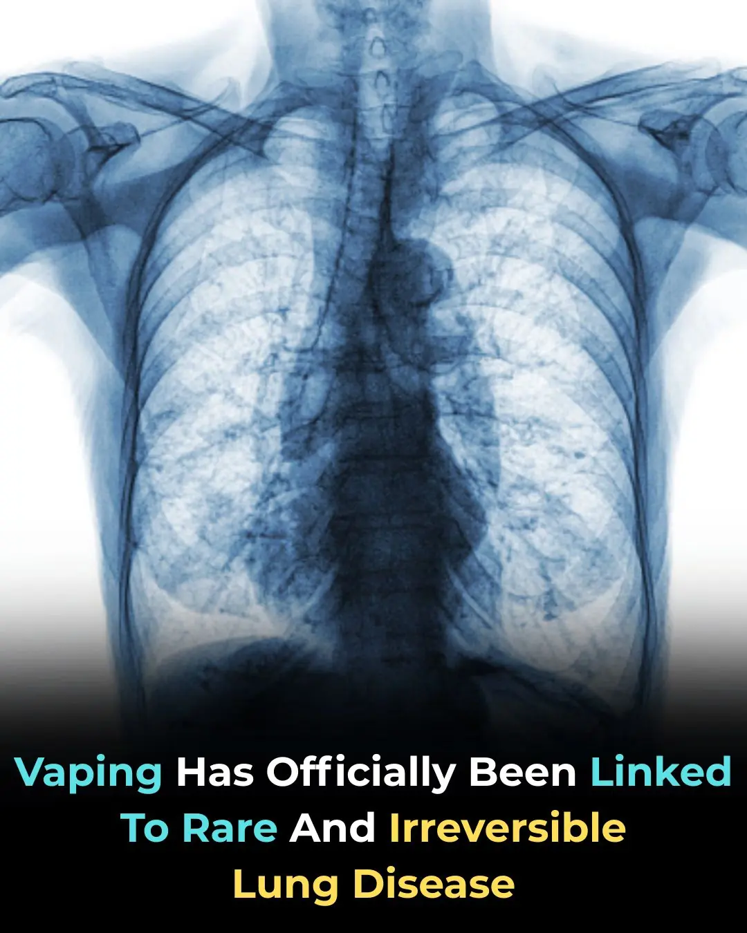 Vaping Linked to Rare and Irreversible Lung Damage: What New Research Reveals