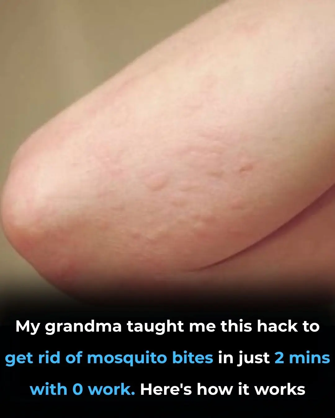 Were You Aware of This? A Surprisingly Simple Spoon Trick Can Stop Mosquito Bite Itching