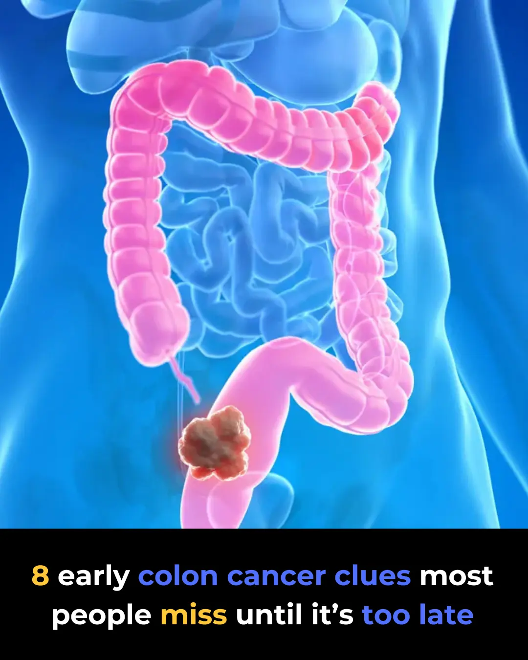 8 Warning Signs of Colon Cancer You Should Never Ignore