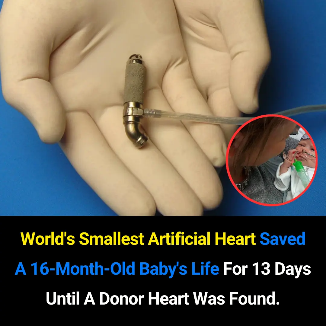 The World’s Smallest Artificial Heart: A Life-Saving Breakthrough for a 16-Month-Old Baby
