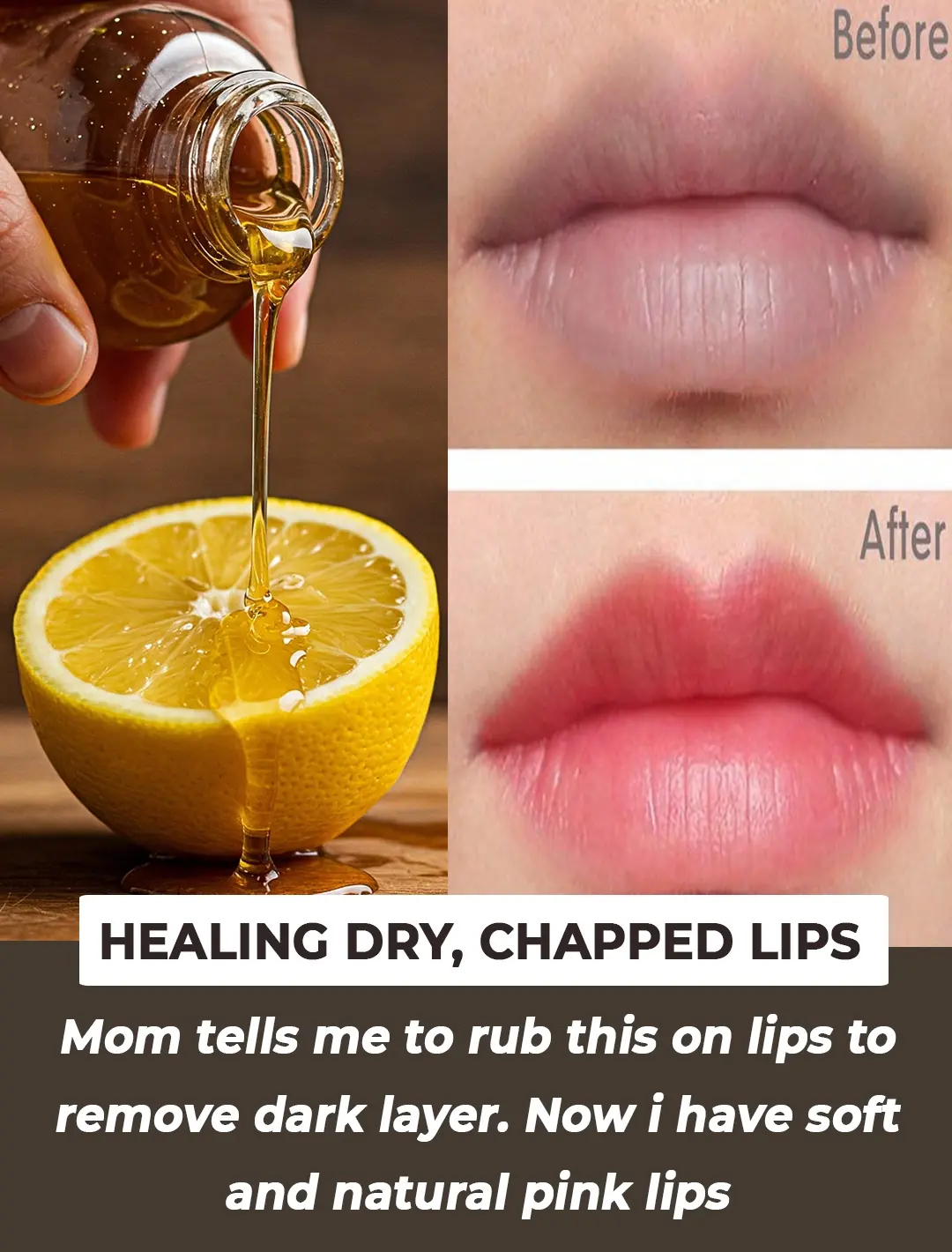 How to Get rid of Chapped Lips, Dry Lips and Cracked Lips