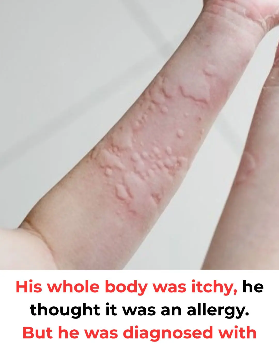 He thought it was just an allergy, until the diagnosis proved otherwise
