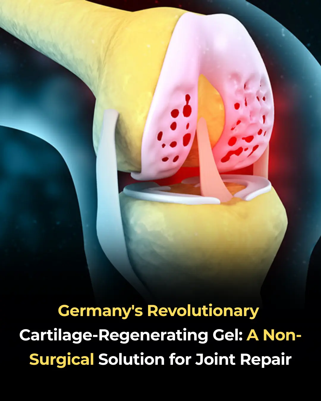 Germany's Revolutionary Cartilage-Regenerating Gel: A Non-Surgical Solution for Joint Repair