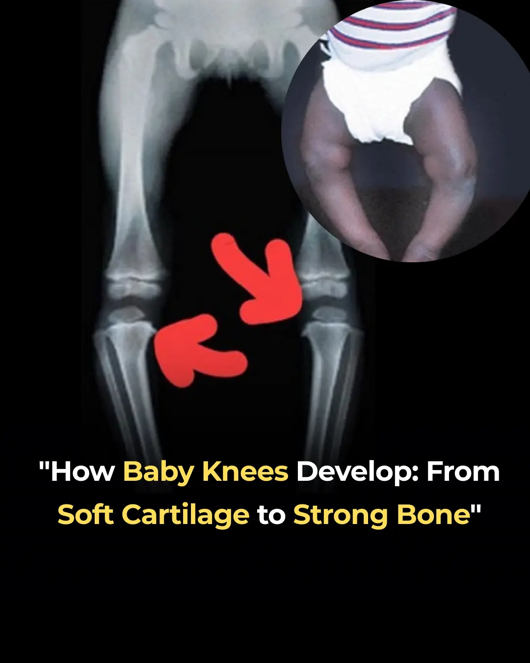 How Baby Knees Develop: From Soft Cartilage to Strong Bone
