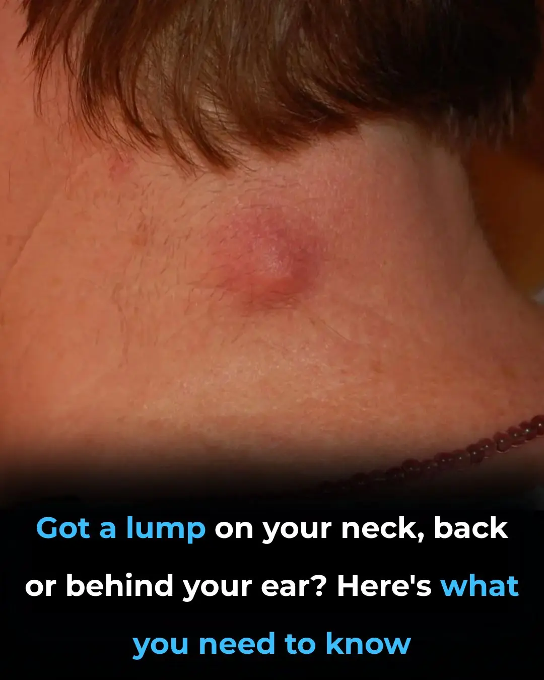 Got a lump on your neck, back or behind your ear? Here’s what you need to know