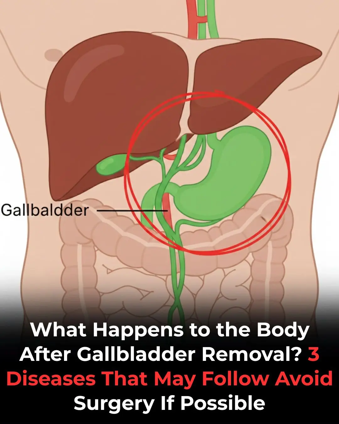 After Gallbladder Removal: 3 Conditions You Could Develop — Why You Should Avoid the Surgery When Possible