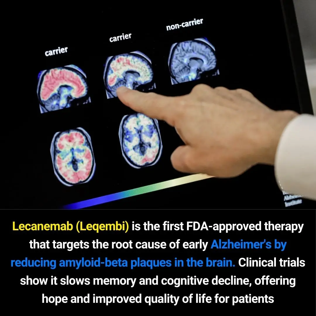 Lecanemab (Leqembi): A Breakthrough Treatment for Early Alzheimer’s That Targets the Disease at Its Source