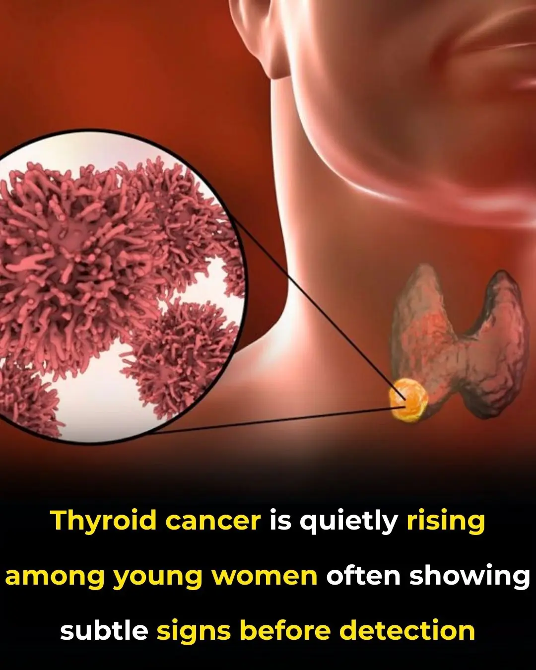 The Hidden Climb of Thyroid Cancer in Younger Women