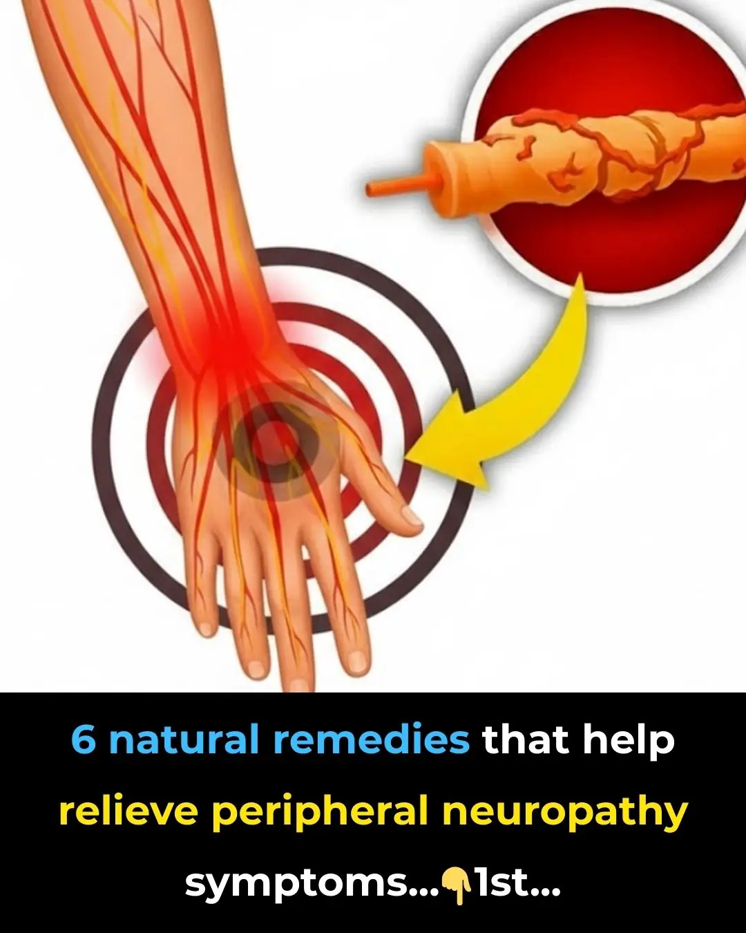 Top 6 Neuropathy Remedies (Peripheral Neuropathy Home Remedies)