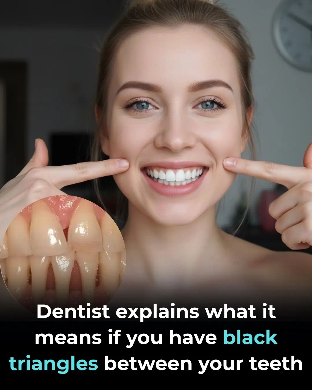 What Are the “Black Triangles” Between Your Teeth