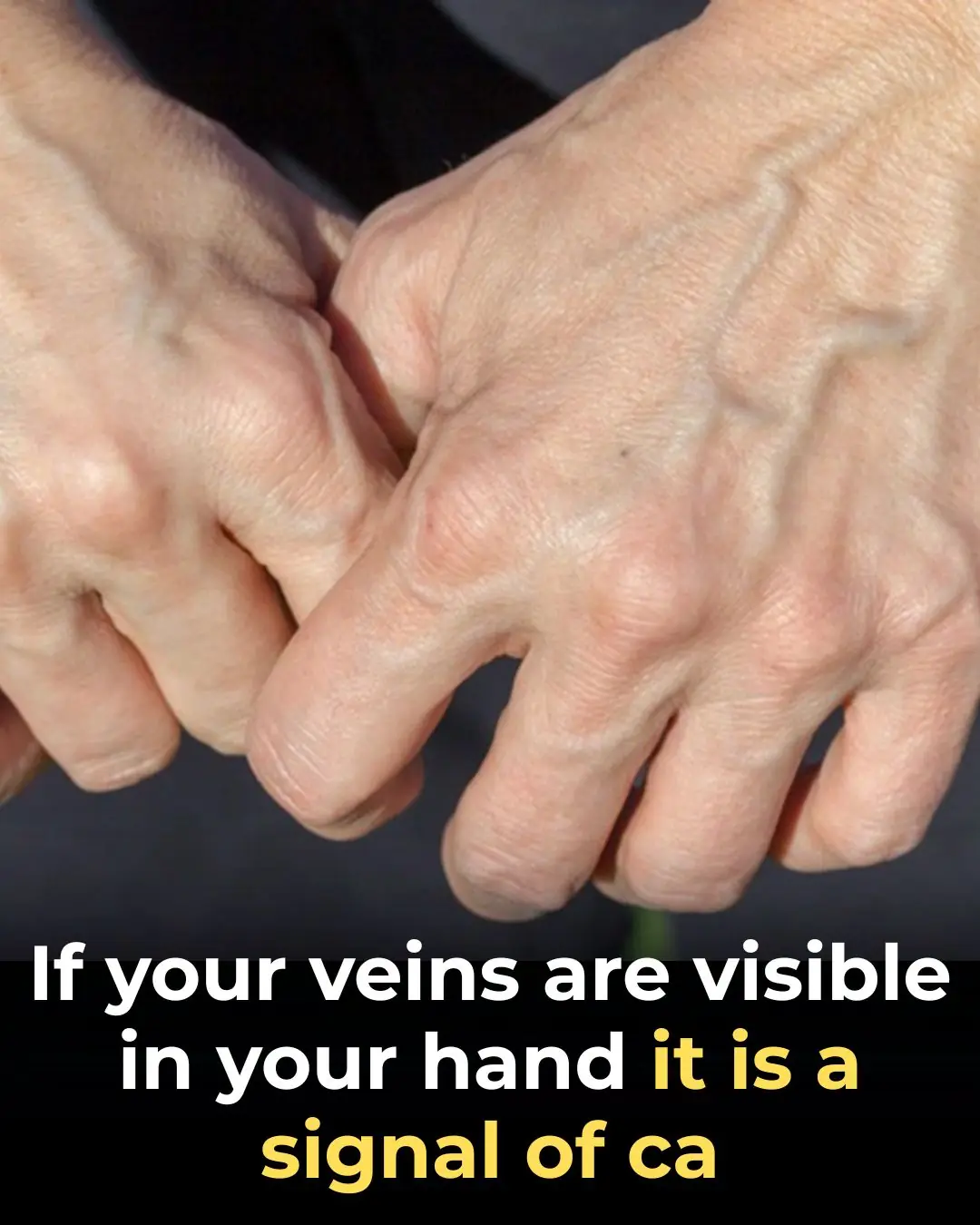 A Complete Guide to Bulging Veins: Causes, Complications, and Care