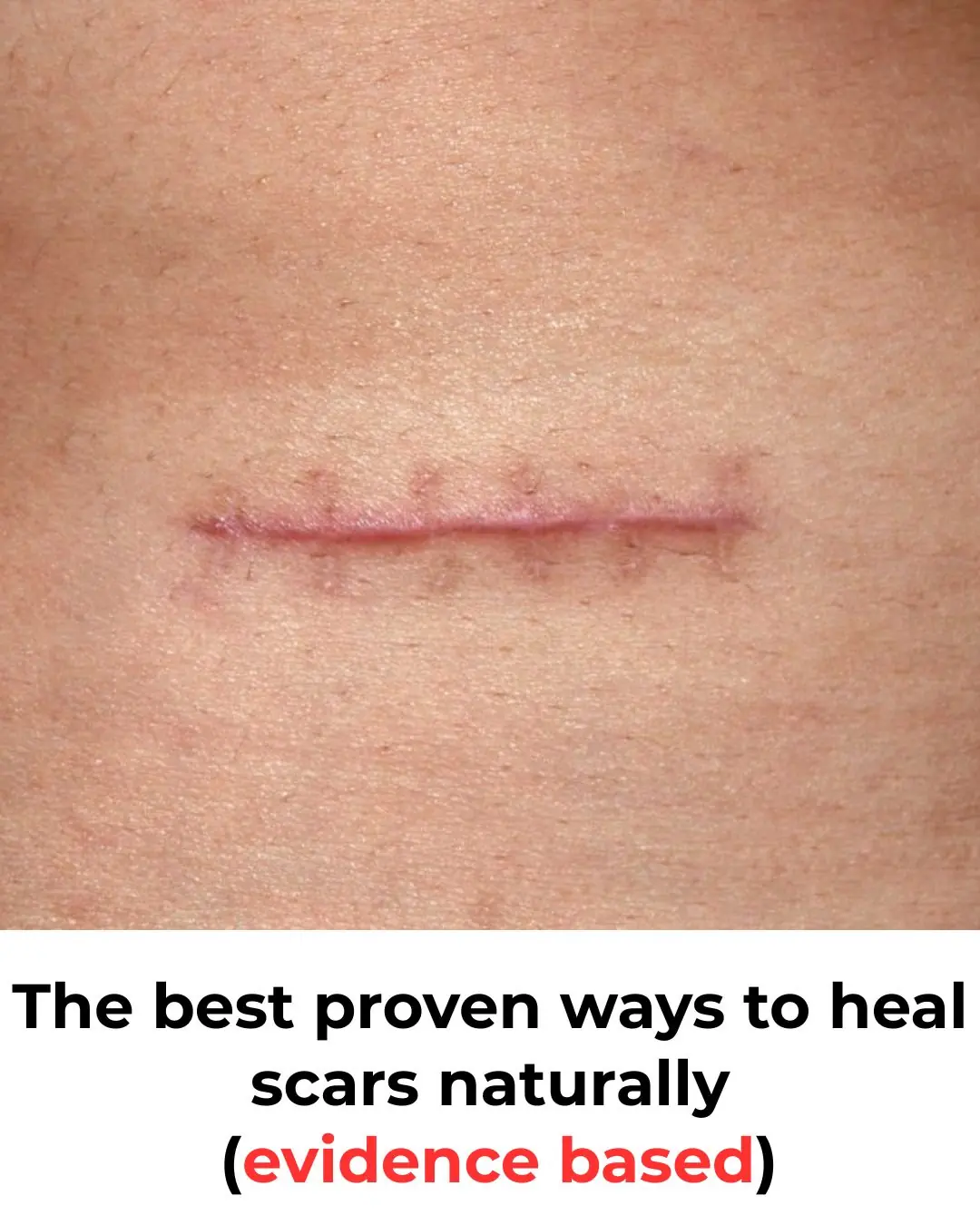 Natural Scar Remedies: How Scars Form and the Most Effective Evidence-Based Treatments to Help Them Fade