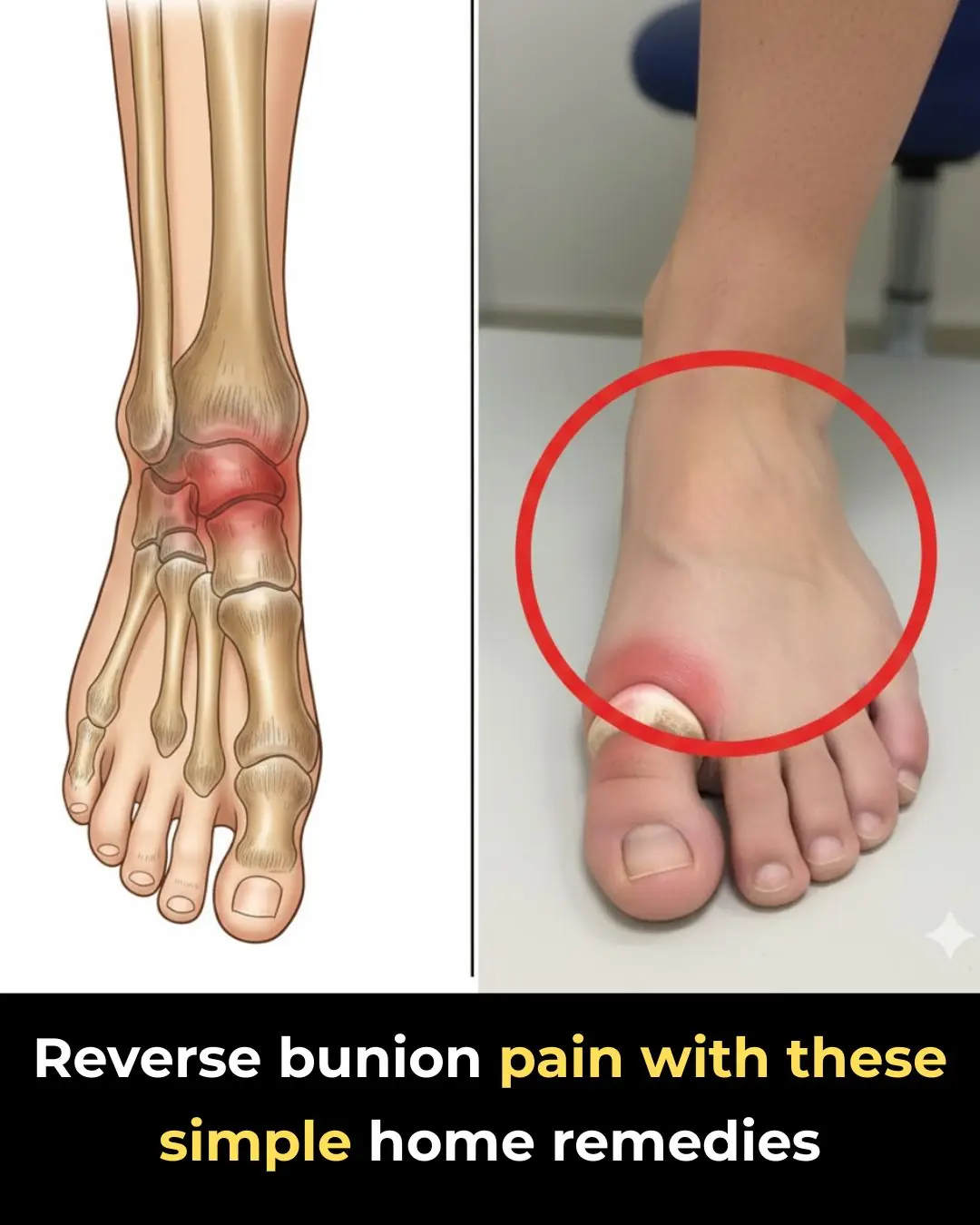Natural Remedies and Prevention Strategies for Bunions: What Really Works