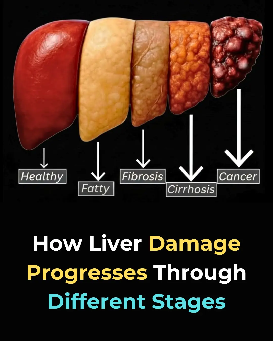 Understanding Liver Damage: Stages, Causes, and How to Prevent It