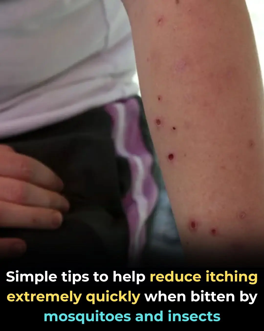 Simple tips to help reduce itching extremely quickly when bitten by mosquitoes and insects