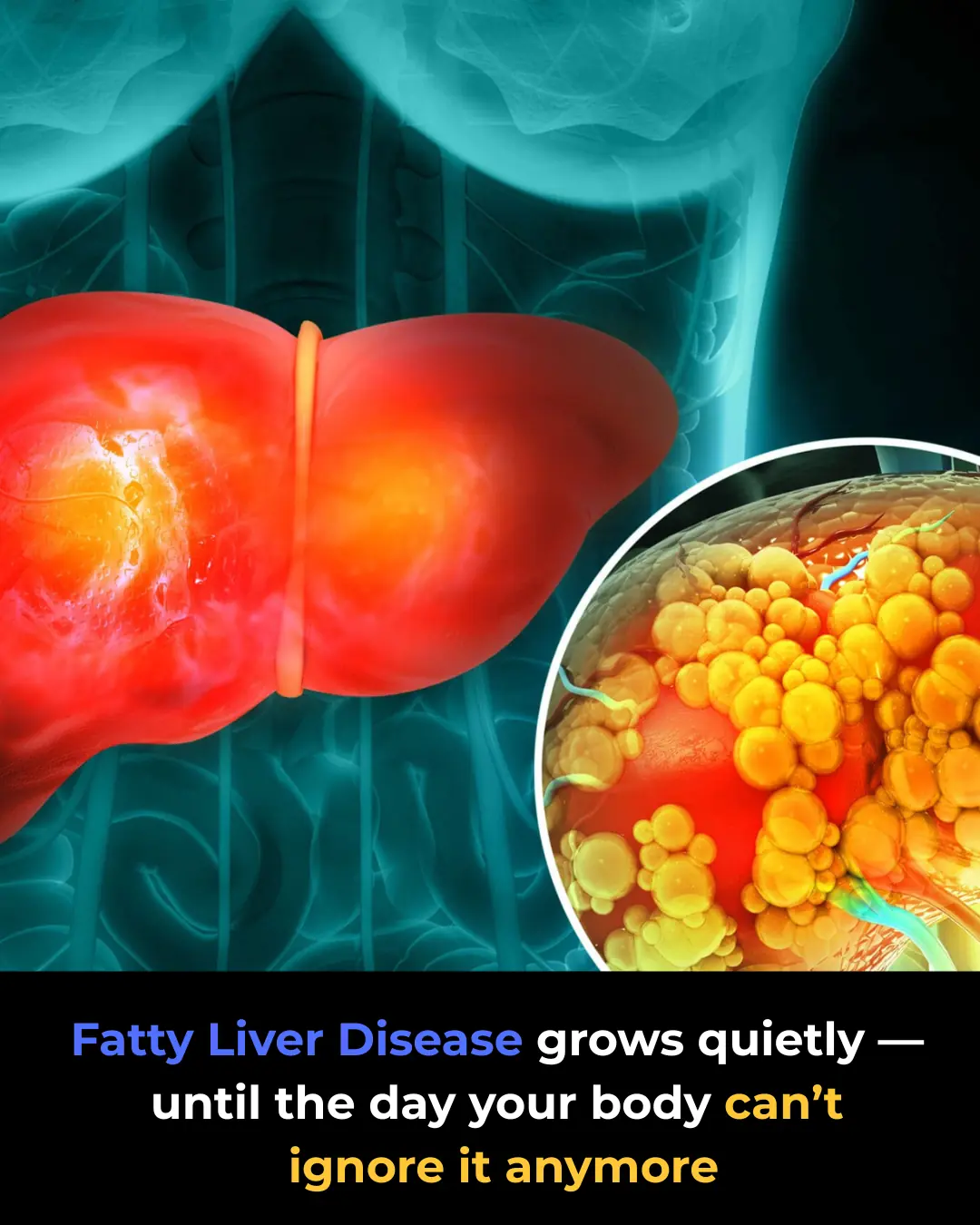 Fatty Liver Disease: What Doctors Want You to Know Early