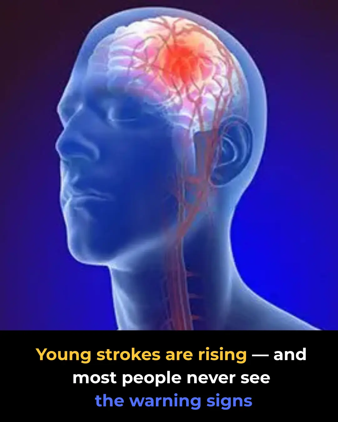 Stroke in Young Adults: Why It’s Becoming More Common