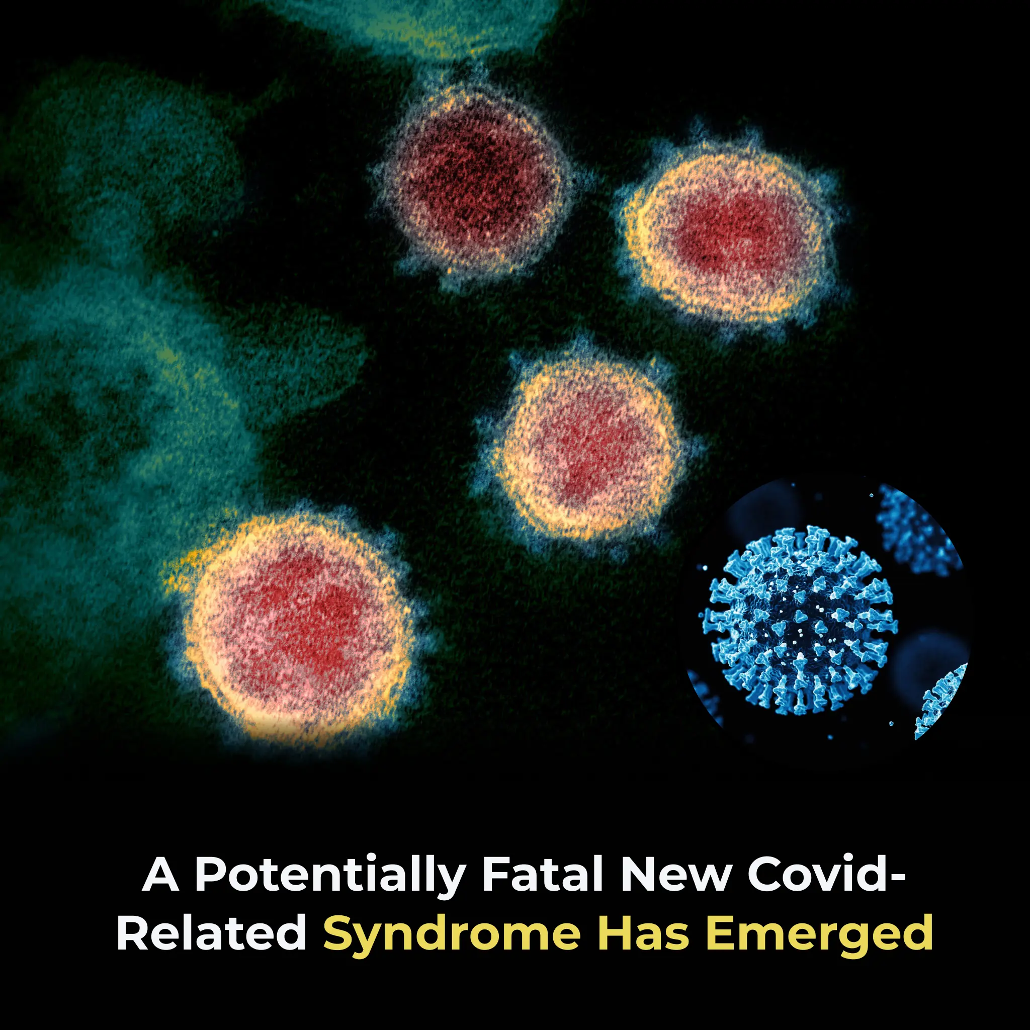 A Potentially Fatal New Covid-related Syndrome Has Emerged