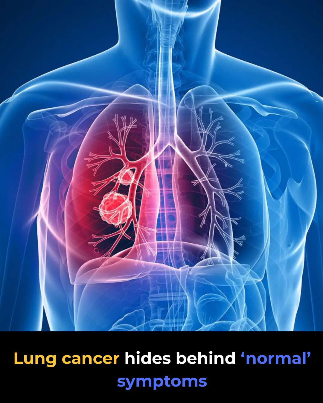 Lung Cancer: 8 Common Symptoms Often Misdiagnosed