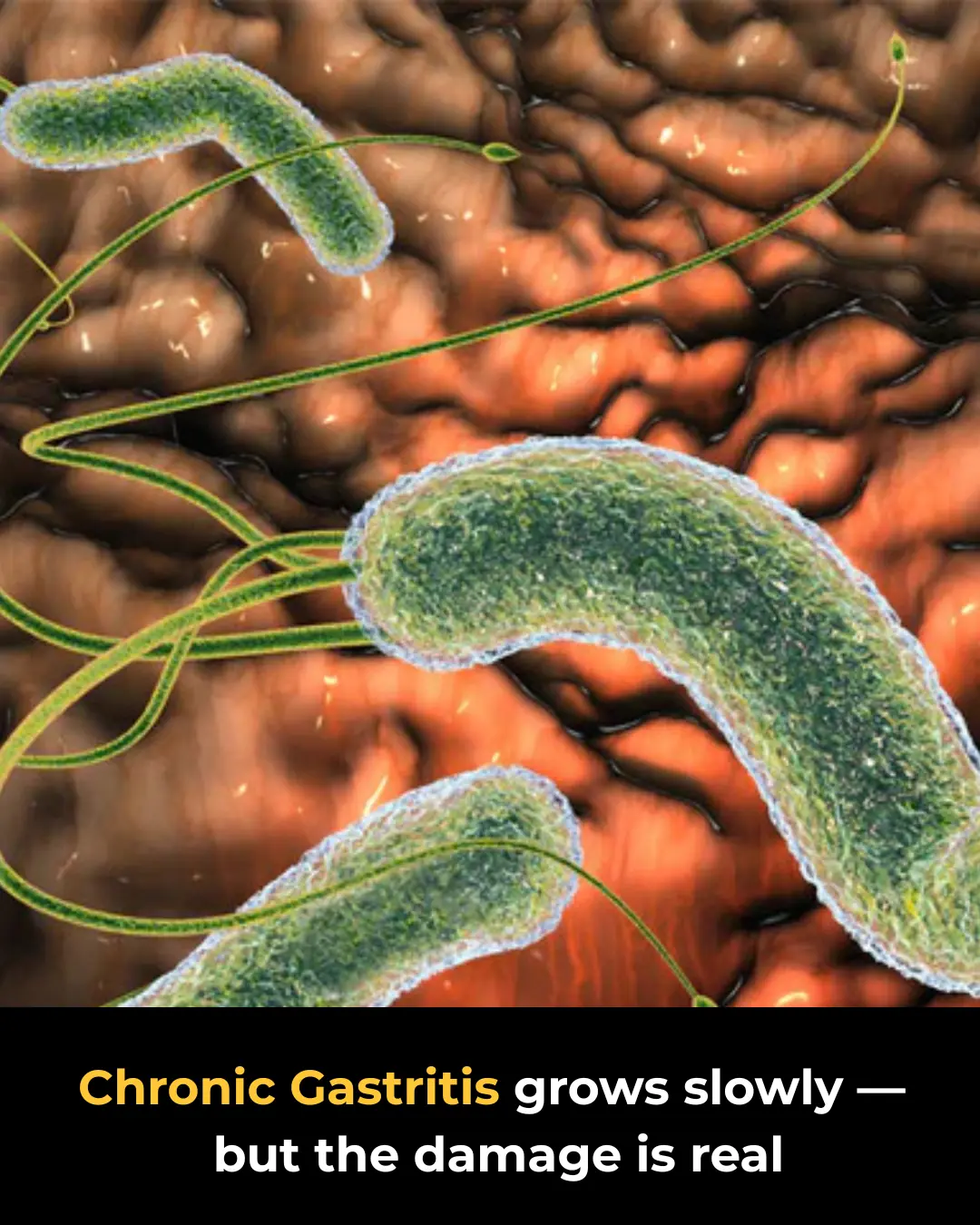 Chronic Gastritis: Causes, Symptoms, and Treatment Options