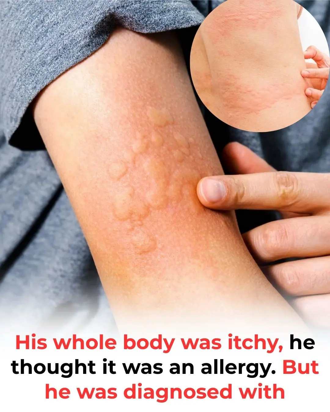 His whole body was itchy, he thought it was an allergy but then he was diagnosed