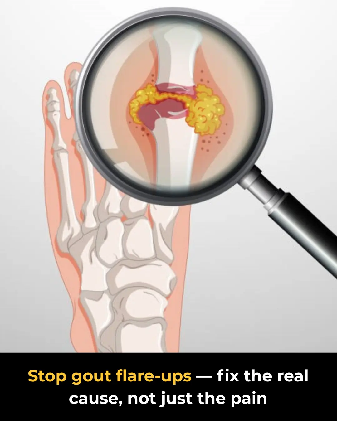 Gout Disease: The Untold Truth and 5 Common Treatment Mistakes