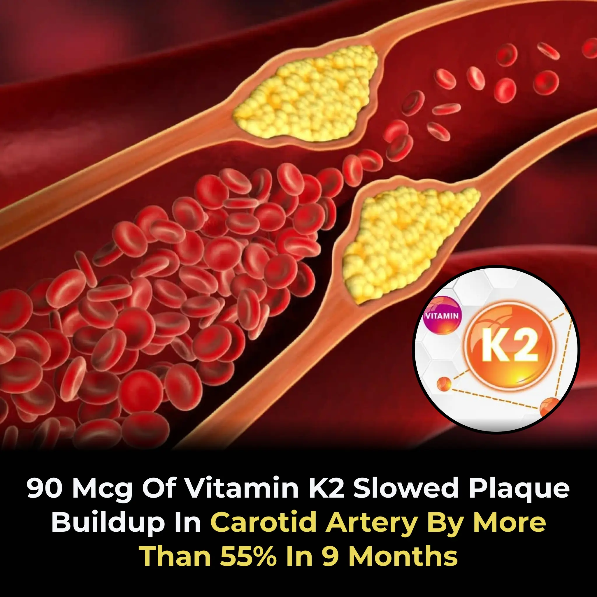 90 mcg of Vitamin K2 Slowed Plaque Buildup in Carotid Artery by More Than 55% in 9 Months