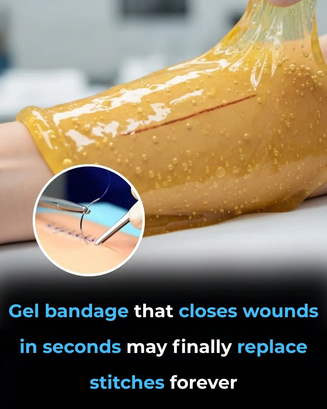 Groundbreaking Gel Bandage Promises to Revolutionize Wound Healing, Replacing Traditional Stitches