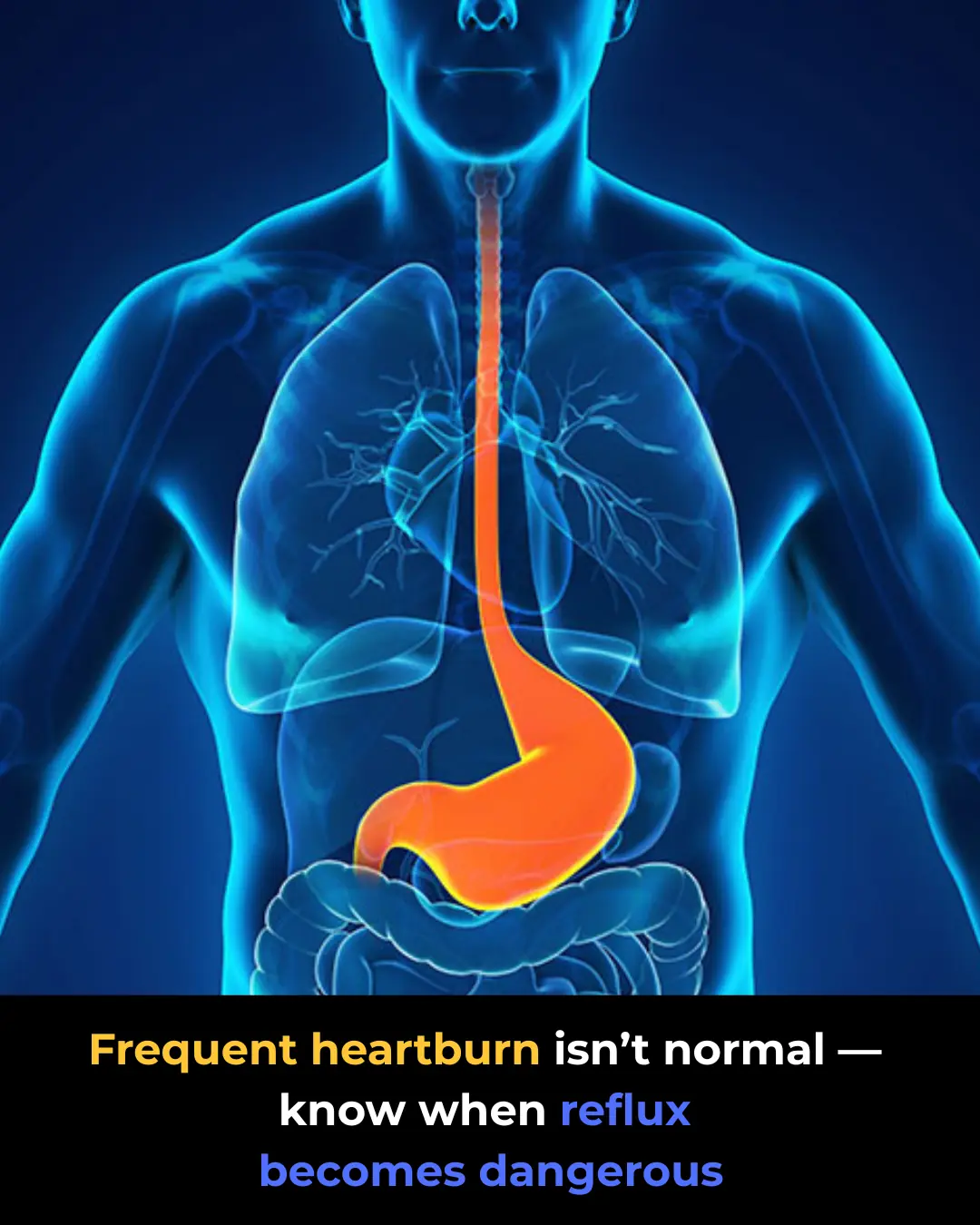 Acid Reflux (GERD): When Should You See a Doctor?