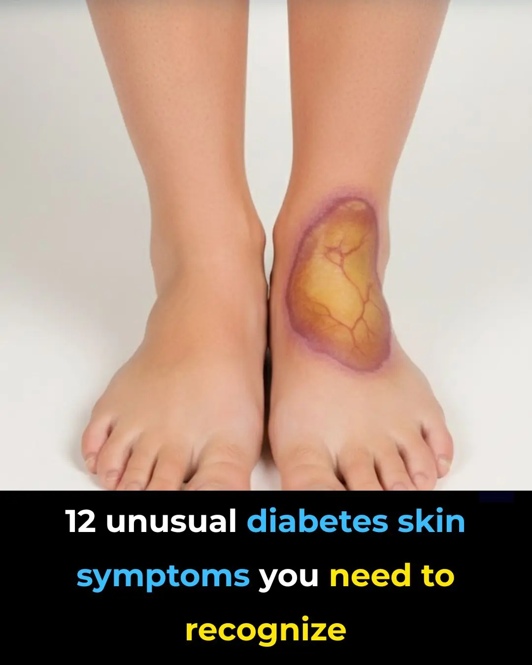 12 Weird Diabetes Skin Problems You Need To Know