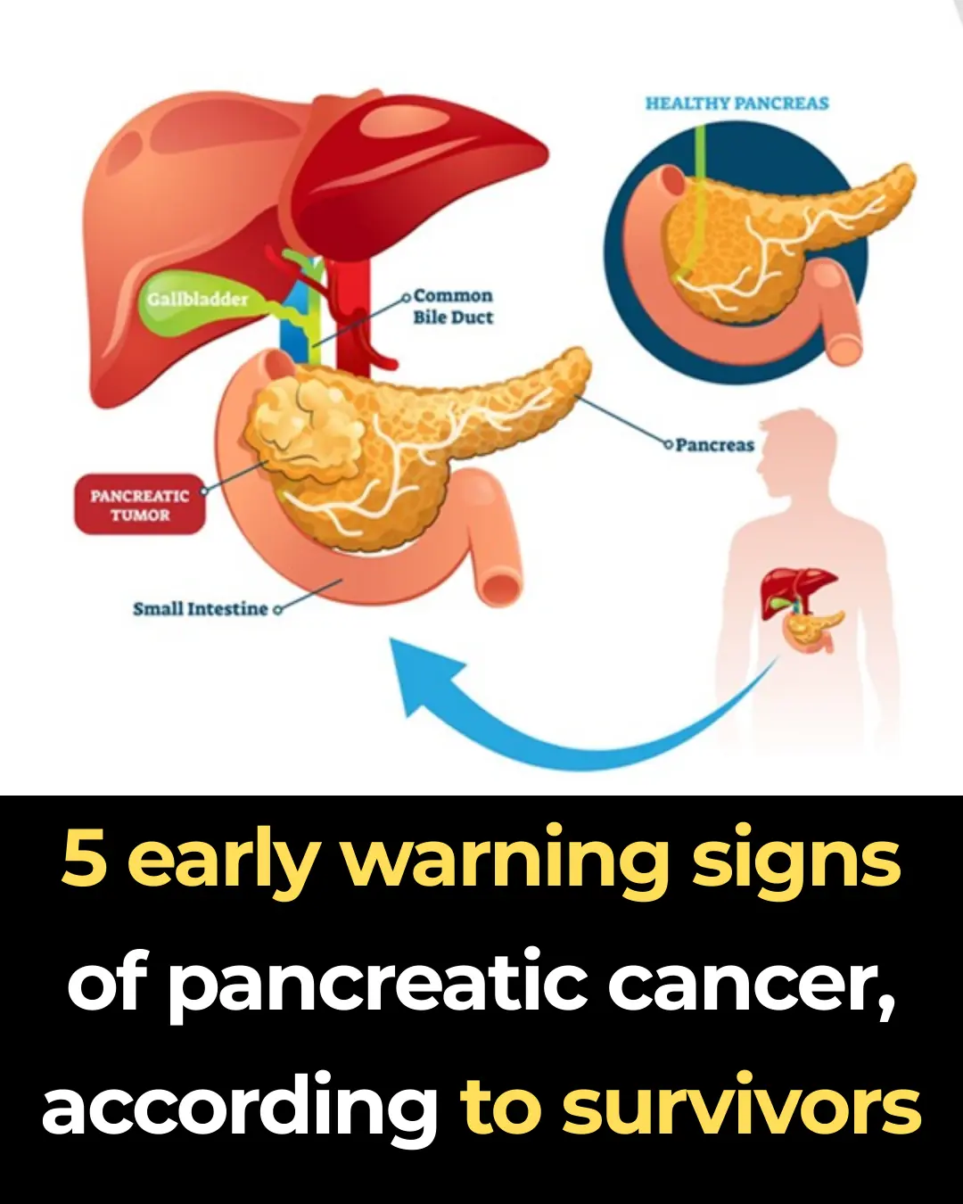5 early warning signs of pancreatic cancer, according to survivors