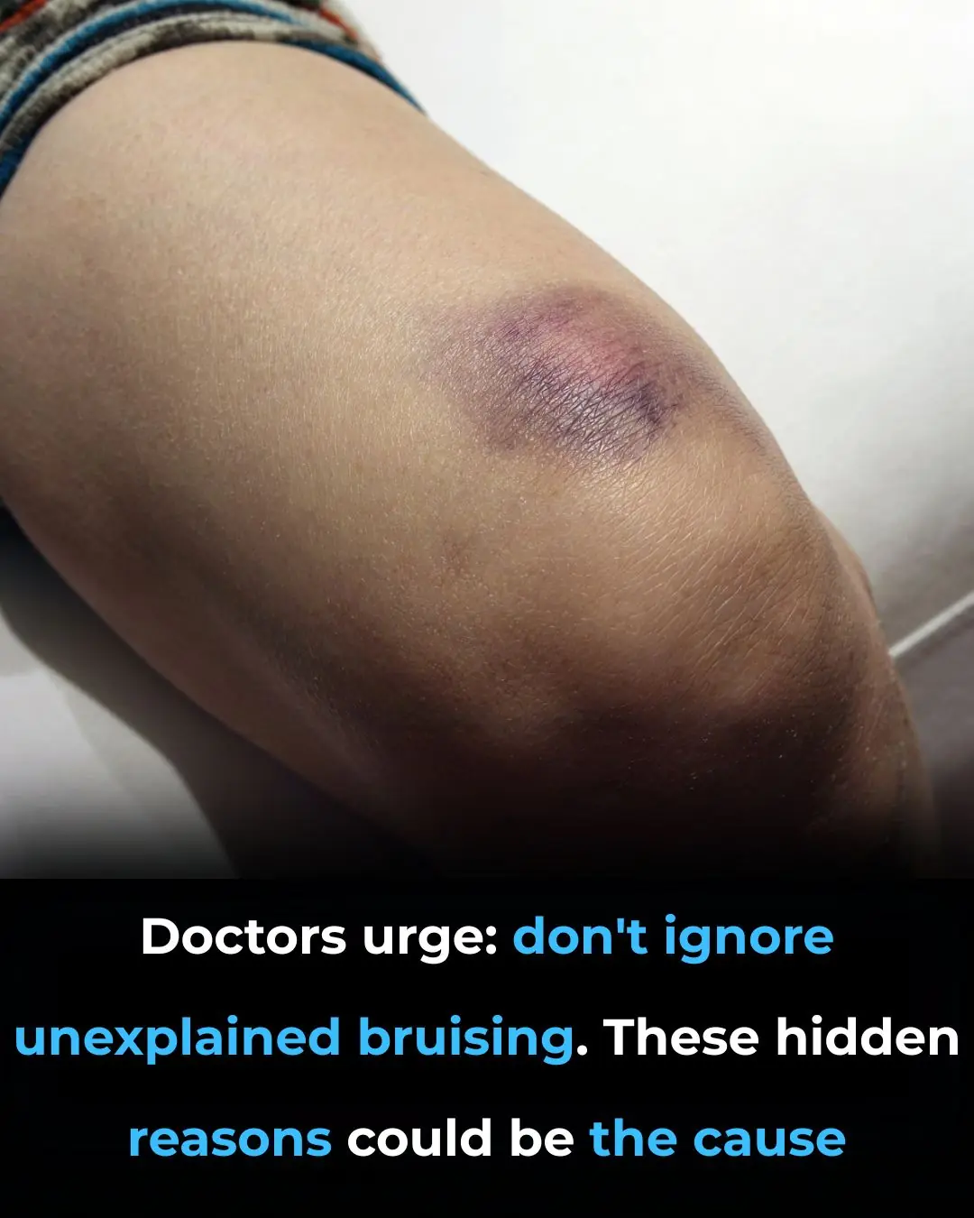 Unexplained Bruising: Common Causes, Warning Signs, and When to Seek Medical Care