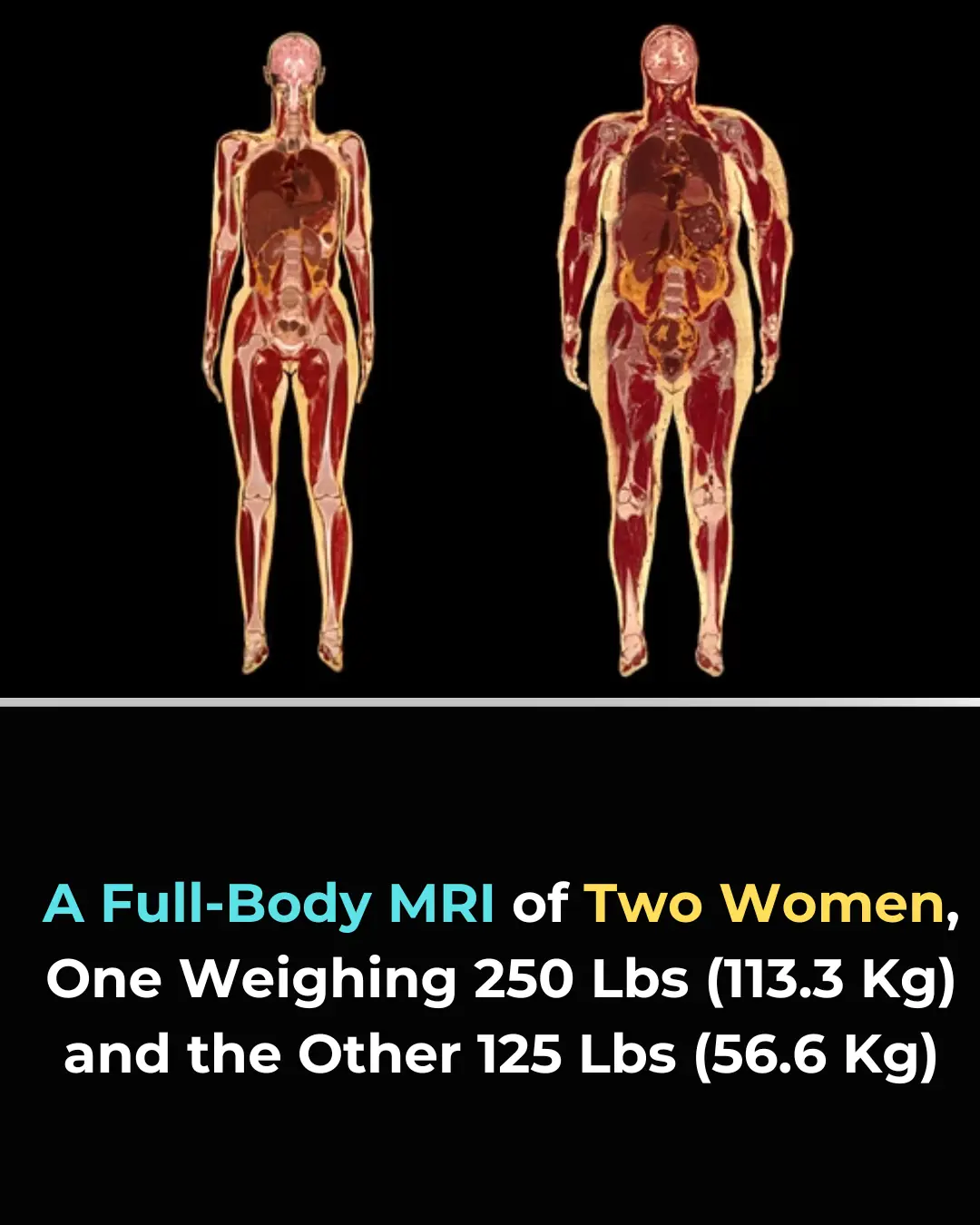 Inside the Human Body: How MRI Images Show the True Impact of Fat Composition