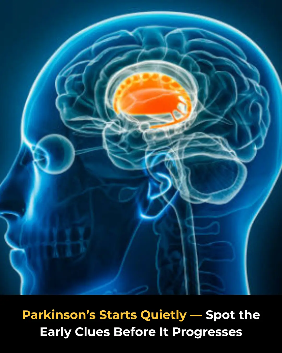 PARKINSON’S DISEASE: EARLY SYMPTOMS PEOPLE OFTEN MISS
