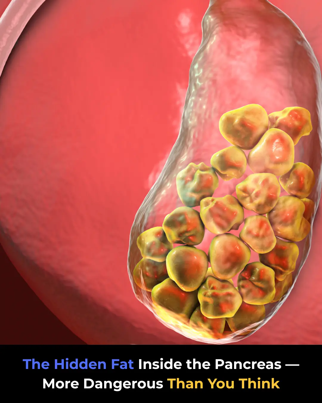 GALLSTONES: SYMPTOMS, CAUSES, AND WHEN SURGERY IS NEEDED