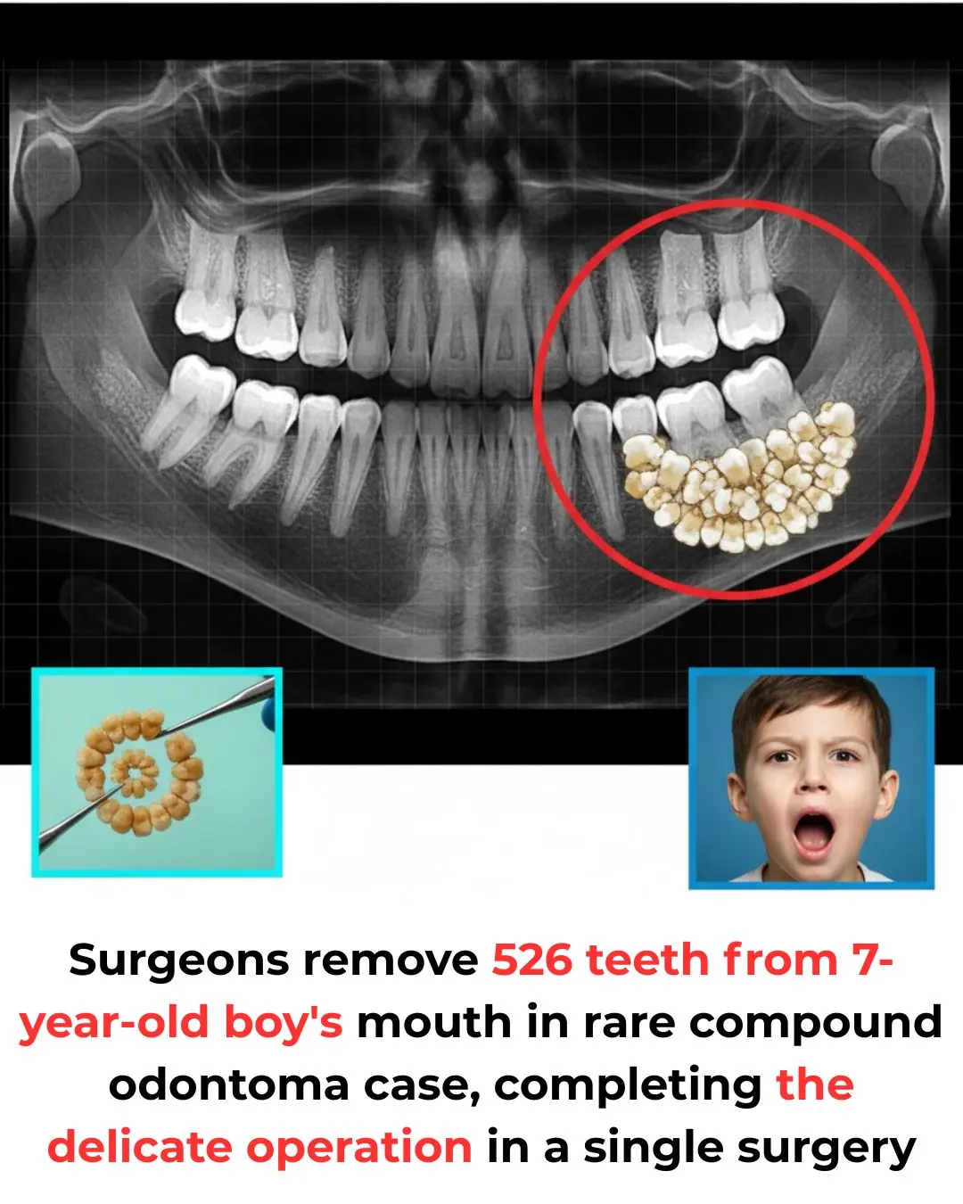 Seven-Year-Old Boy in India Undergoes Surgery to Remove Rare Jaw Tumor Containing 526 Tiny Teeth