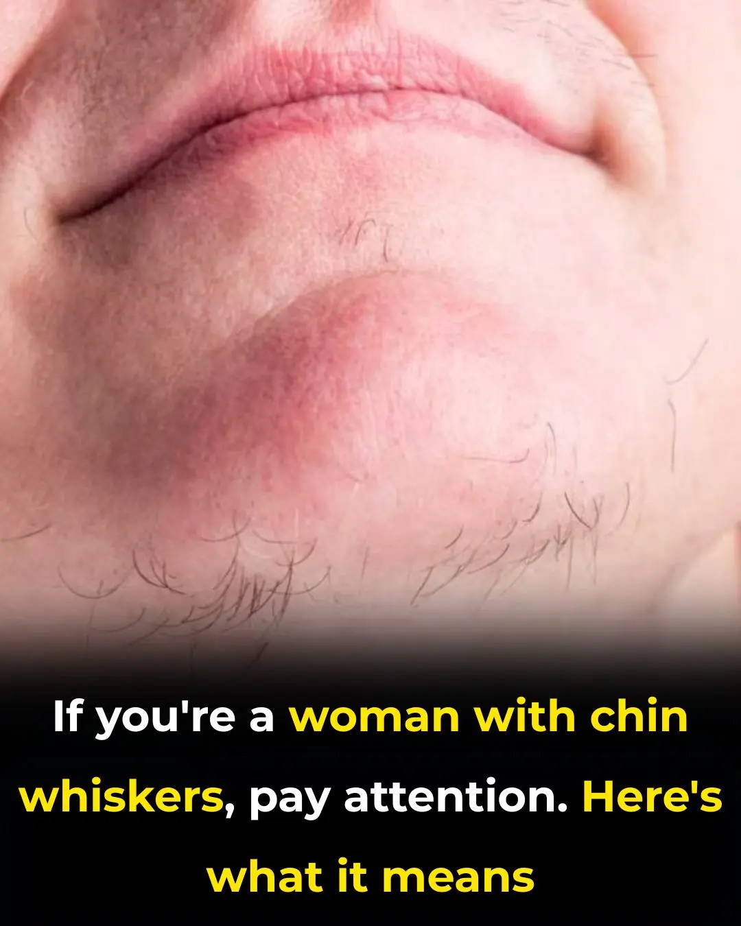 Chin Whiskers in Women