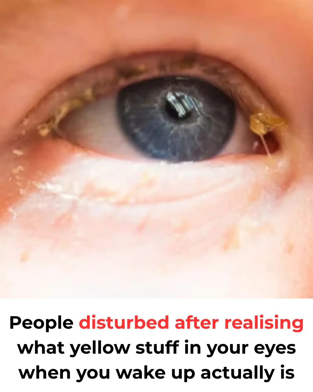 What Yellow Stuff In Your Eyes When You Wake Up Actually Is