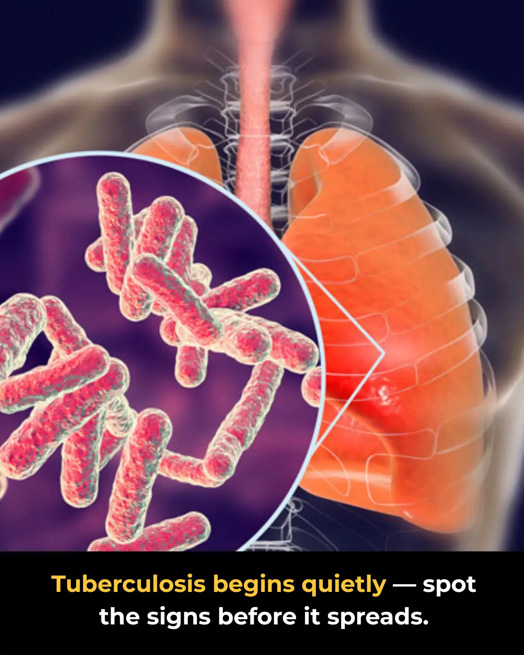 Tuberculosis Symptoms: What You Need to Know Early