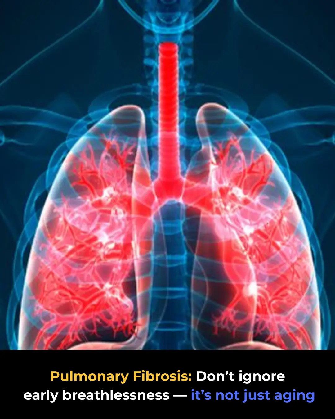 Pulmonary Fibrosis: Early Signs and Treatment Options