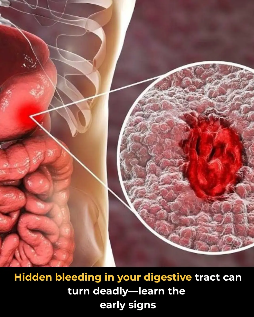 Gastrointestinal Bleeding: Causes and Red-Flag Symptoms