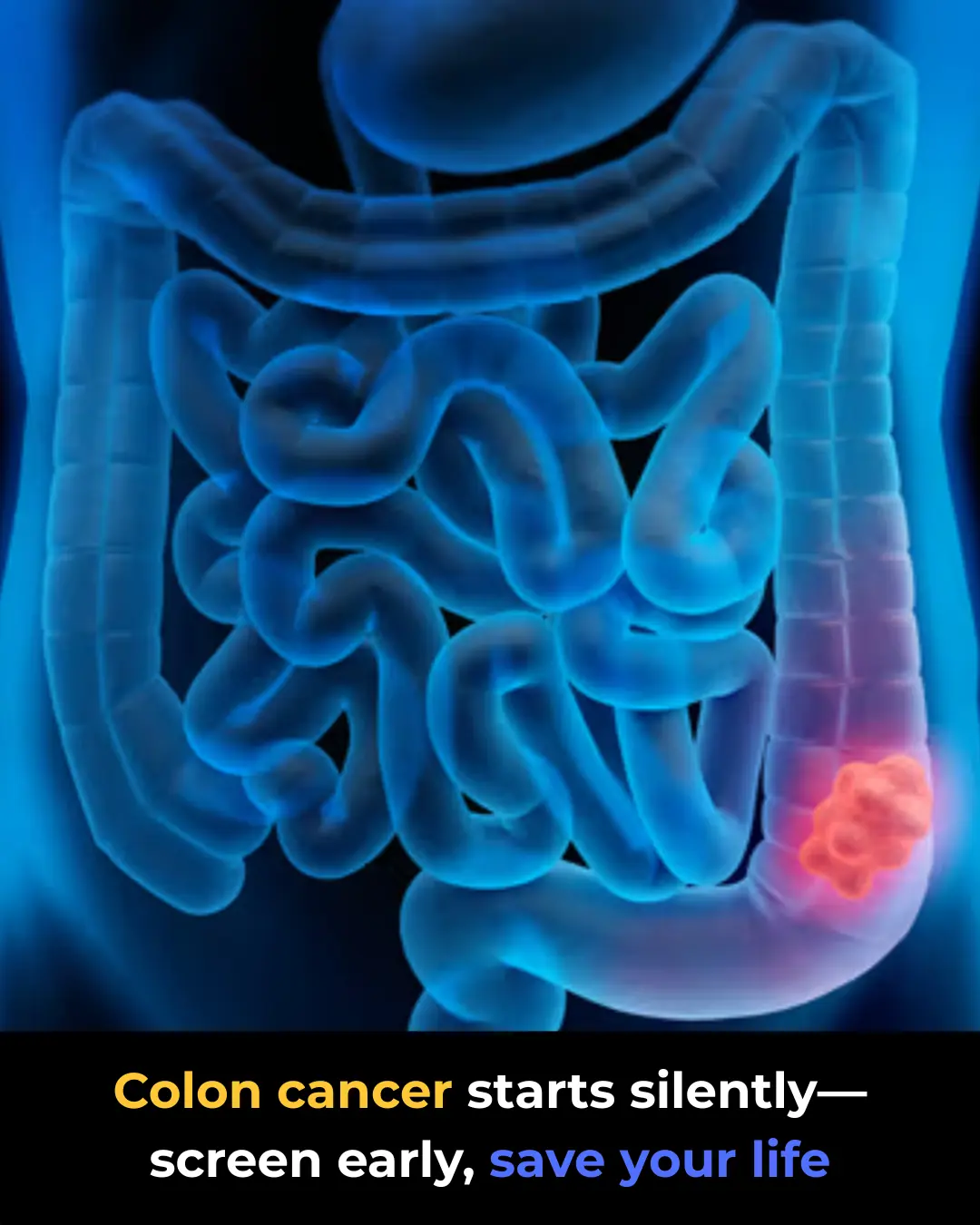 Colon Cancer: Why Early Screening Saves Lives